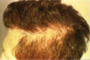 Person sufferng alopecia.